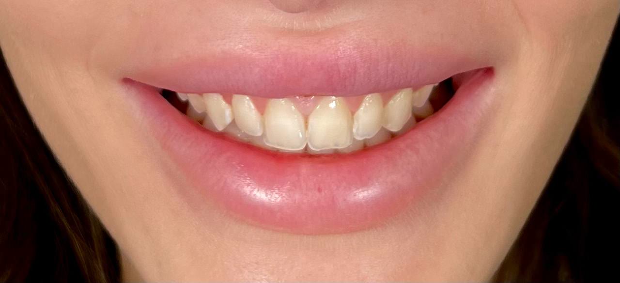 Исходная улыбка пациента до начала работы